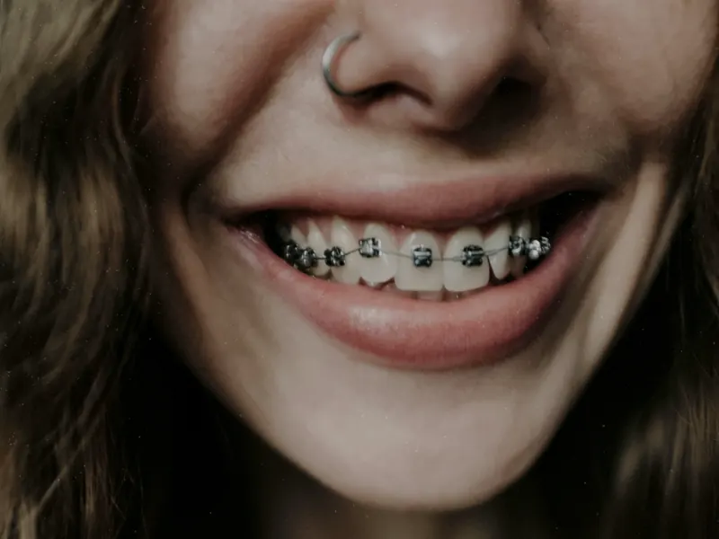 Sonrisa de cerca con brackets puestos