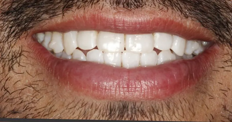 Sonrisa del mismo paciente antes del tratamiento, con espacios entre los dientes