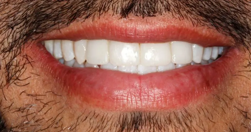 Sonrisa de un paciente después del tratamiento, con los dientes parejos y sin espacios