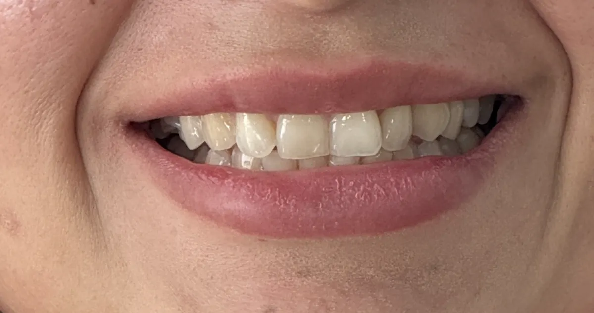 Sonrisa de la misma paciente antes del tratamiento, con los dientes encimados