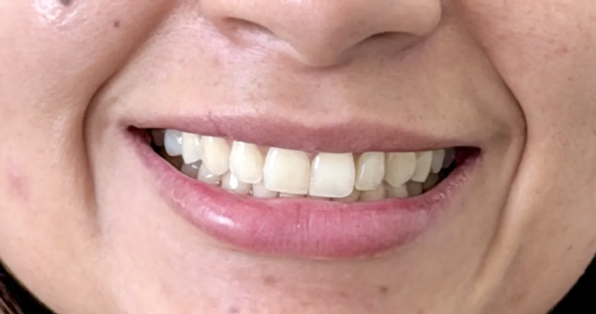 Sonrisa de una paciente después del tratamiento, con los dientes alineados