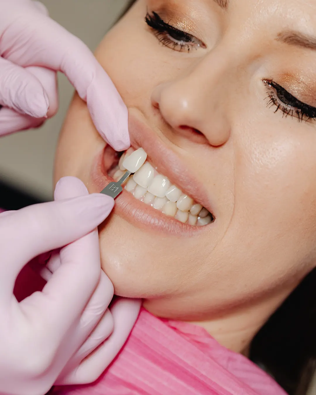 Una guía de tonos junto a los dientes de una paciente para elegir el color de sus carillas
