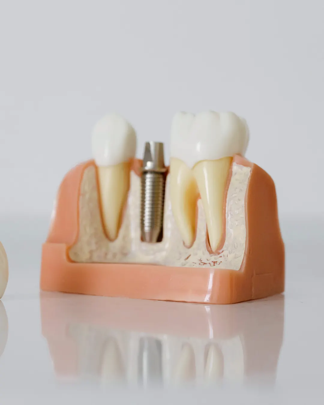 Modelo de un implante dental entre dos dientes, con la raíz de titanio a la vista